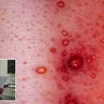Measles Resurgence in England: A Preventable Tragedy