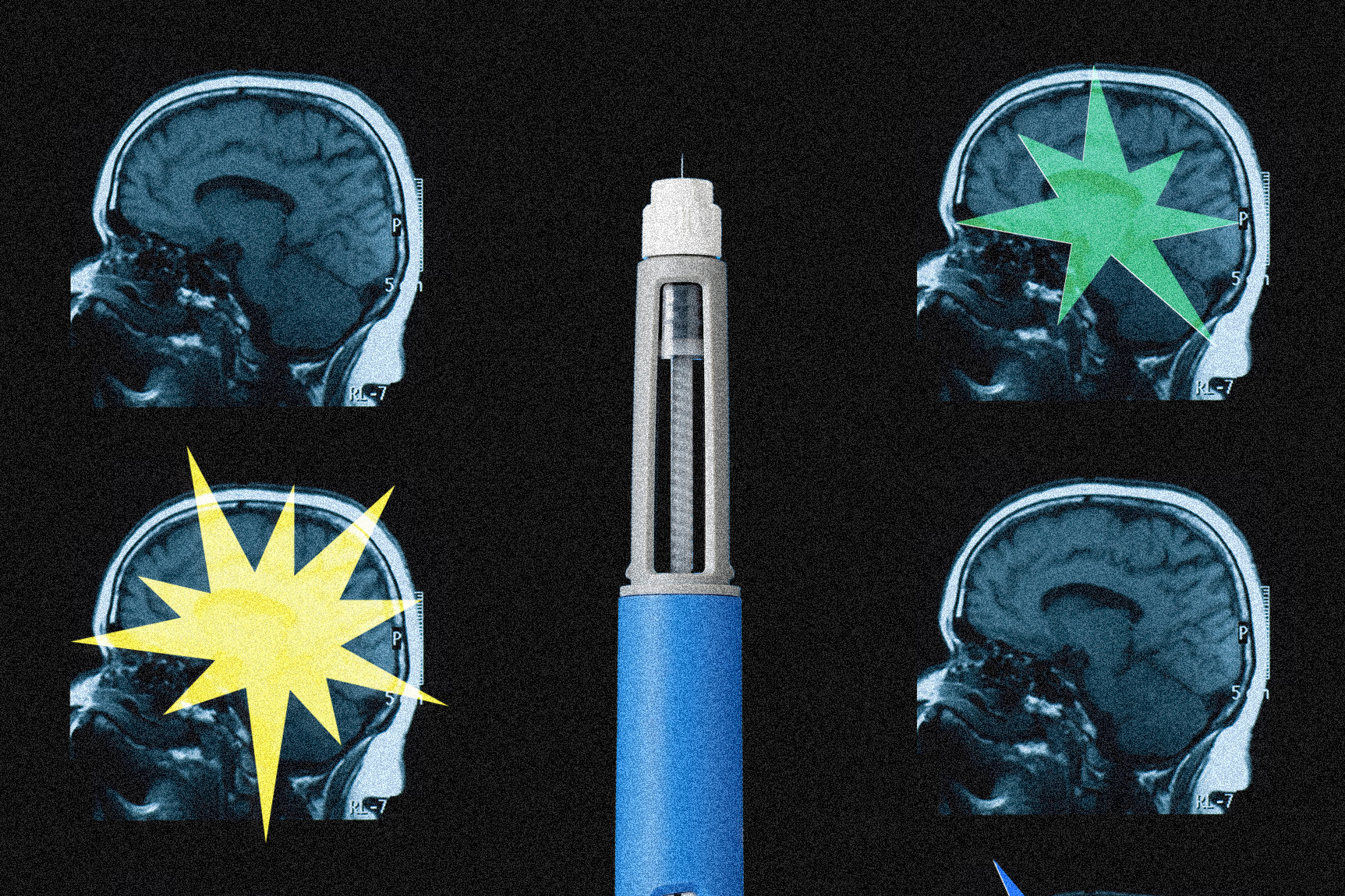 Ozempic’s Enigmatic Enigma: A Deep Dive into the Drug’s Potential Neural Revisions Ozempic’s Enigmatic Enigma: A Deep Dive into the Drug’s Potential Neural Revisions