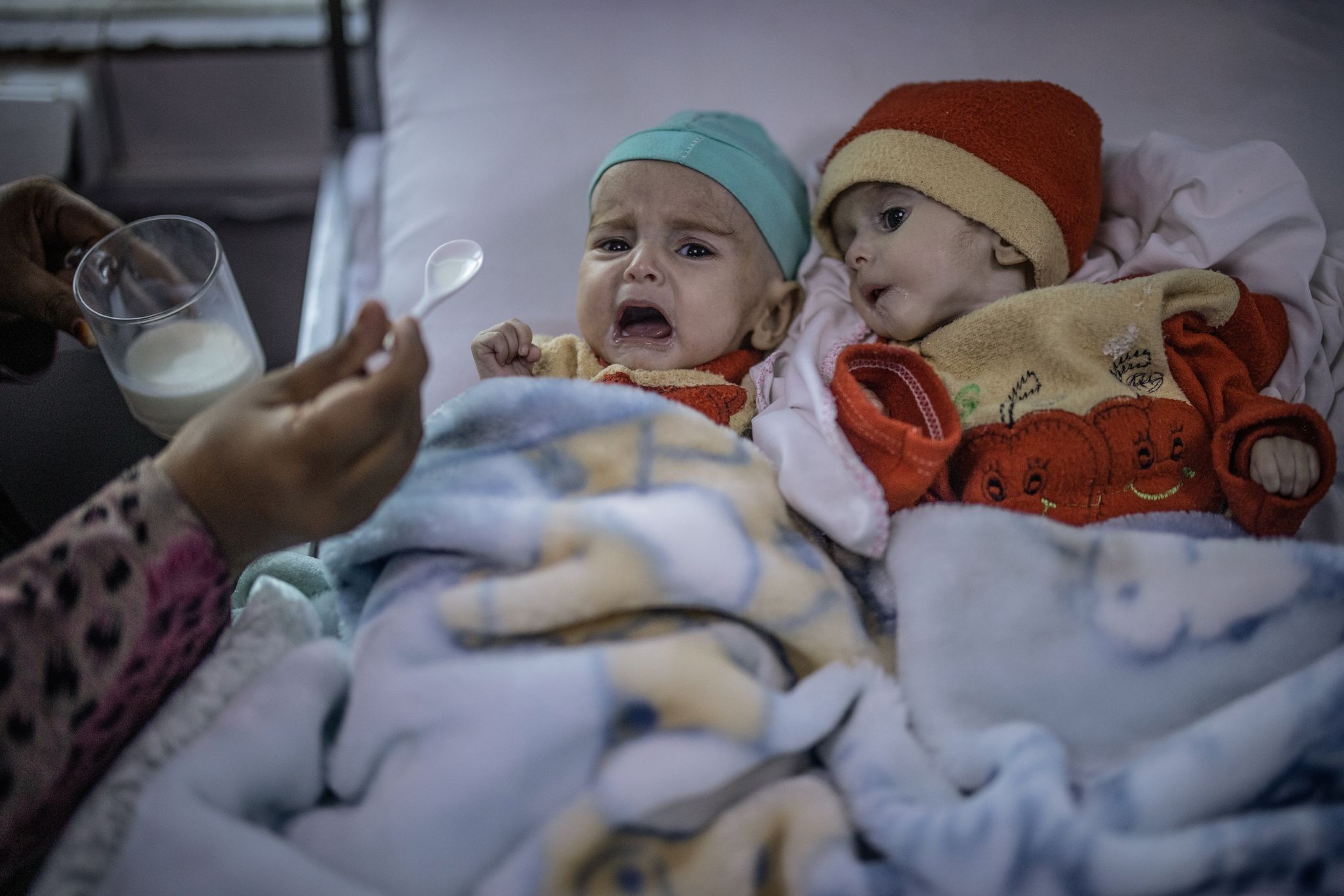 Kabul’s Silent Attrition: Child Malnutrition Surges as Afghanistan Slips from Global View Kabul’s Silent Attrition: Child Malnutrition Surges as Afghanistan Slips from Global View