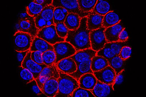 Pancreatic Cancer’s ‘Undruggable’ Curse Meets its Match: A New Pill’s Unsettling Promise Pancreatic Cancer’s ‘Undruggable’ Curse Meets its Match: A New Pill’s Unsettling Promise