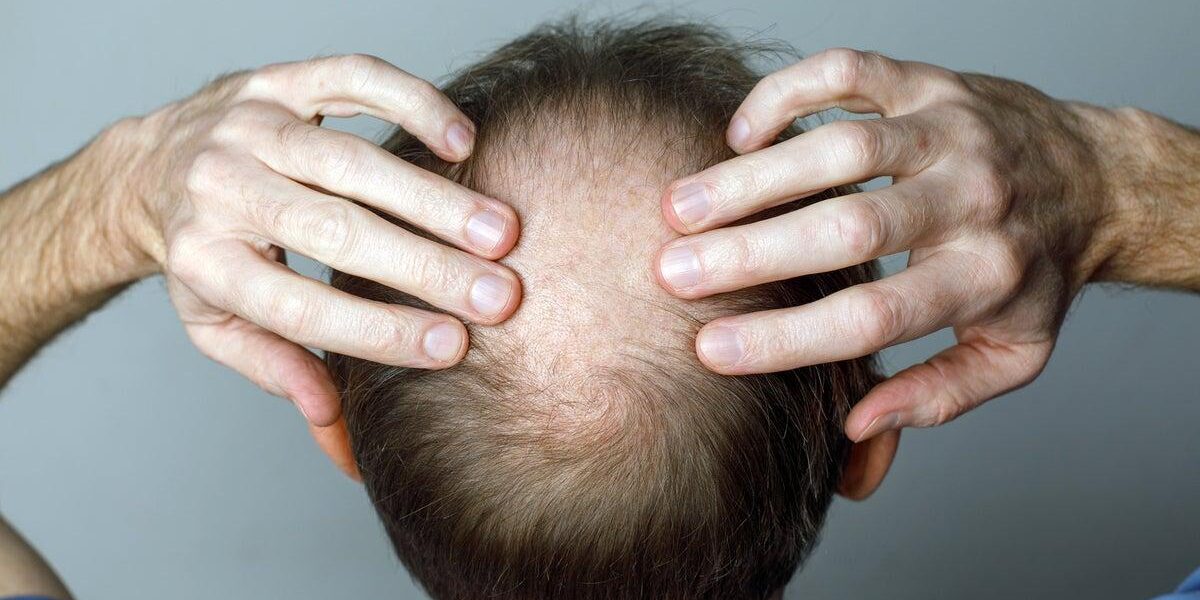 New Study Reveals Weight Loss Drugs May Cause Hair Loss New Study Reveals Weight Loss Drugs May Cause Hair Loss