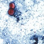 UK Issues Holiday Warning as Cyclospora Outbreak Spreads UK Issues Holiday Warning as Cyclospora Outbreak Spreads