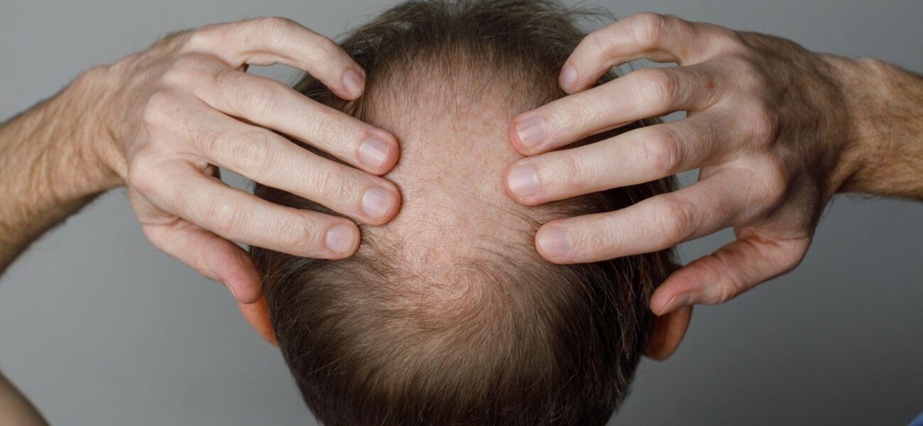 Study Links Weight Loss Medications to Increased Hair Loss Risk Study Links Weight Loss Medications to Increased Hair Loss Risk