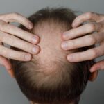 Study Links Weight Loss Medications to Increased Hair Loss Risk Study Links Weight Loss Medications to Increased Hair Loss Risk