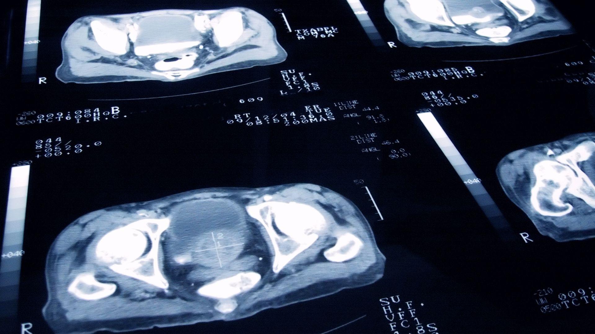 New Prostate Cancer Treatment Equals Radiotherapy Efficacy with Fewer Side Effects New Prostate Cancer Treatment Equals Radiotherapy Efficacy with Fewer Side Effects