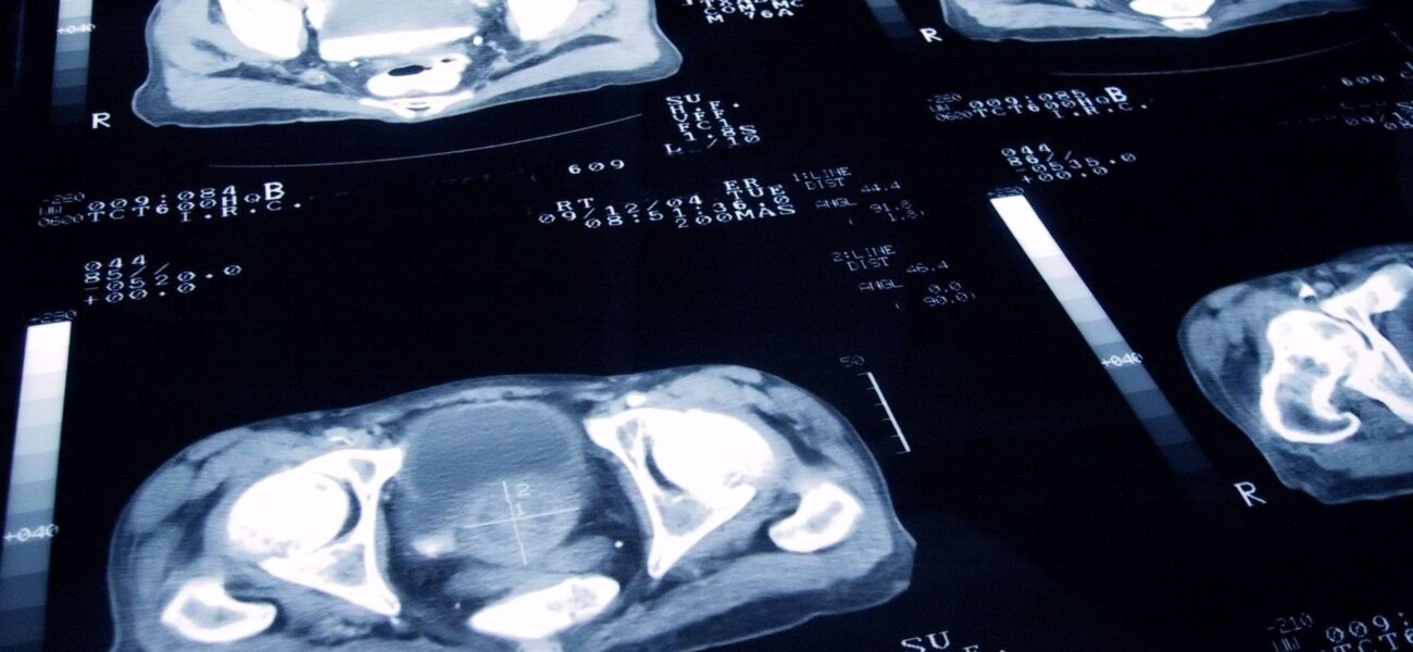 New Prostate Cancer Treatment Shows Comparable Efficacy to Radiotherapy with Fewer Side Effects New Prostate Cancer Treatment Shows Comparable Efficacy to Radiotherapy with Fewer Side Effects