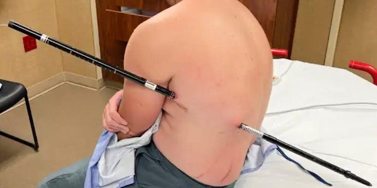 Montana Hiker Impaled by Trekking Pole Successfully Seeks Help