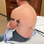 Montana Hiker Impaled by Trekking Pole Successfully Seeks Help Montana Hiker Impaled by Trekking Pole Successfully Seeks Help