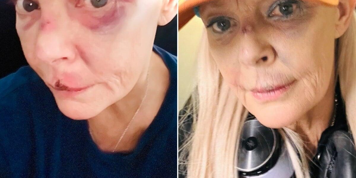 Gail Porter Reveals Gruesome Injuries Following London Incident Gail Porter Reveals Gruesome Injuries Following London Incident