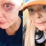 Gail Porter Reveals Gruesome Injuries Following London Incident Gail Porter Reveals Gruesome Injuries Following London Incident