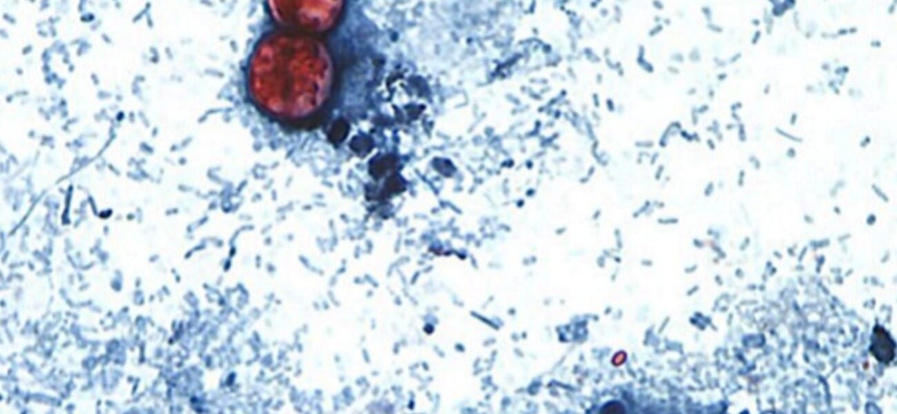 Silent Spoilers: Cyclosporiasis’ Tricky Grip on Global Public Health Systems Silent Spoilers: Cyclosporiasis’ Tricky Grip on Global Public Health Systems