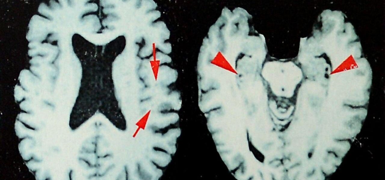 Study Reveals Elevated Rates of Degenerative Brain Disease Among Deceased NFL Players