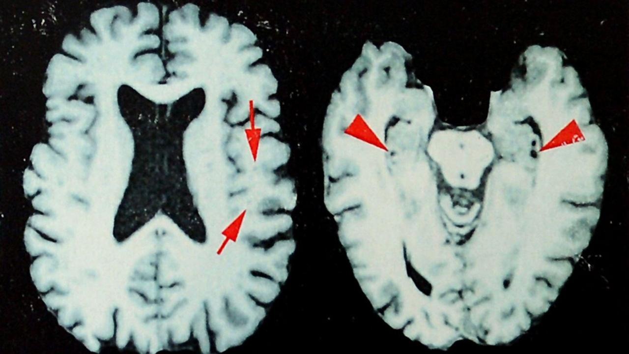 Study Reveals Elevated Rates of Degenerative Brain Disease Among Deceased NFL Players Study Reveals Elevated Rates of Degenerative Brain Disease Among Deceased NFL Players