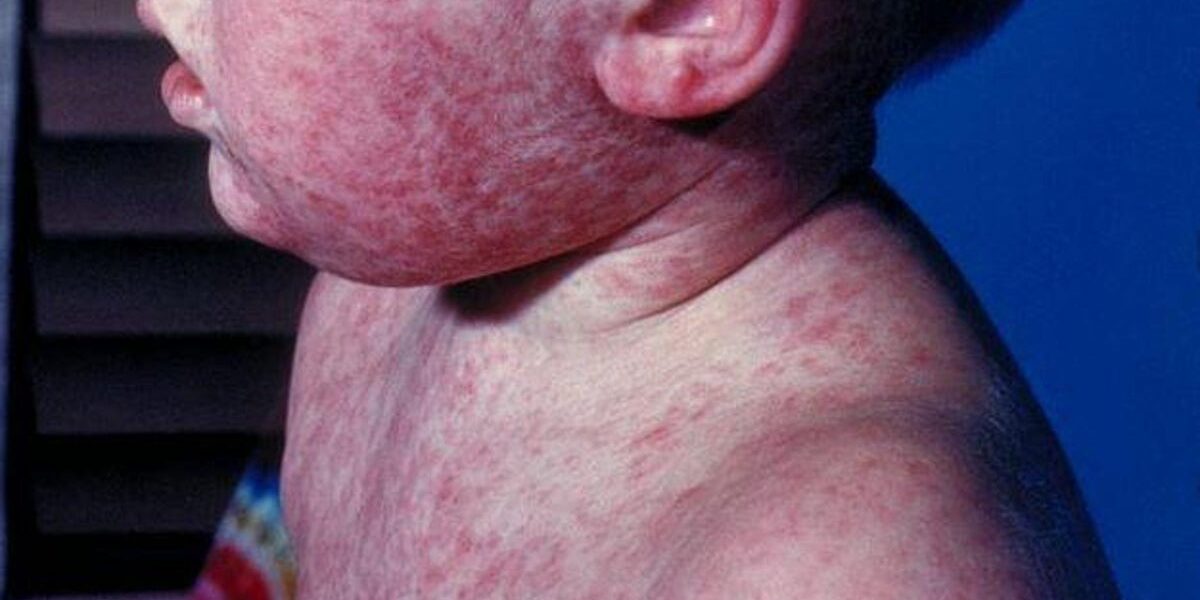 Pennsylvania Records First Measles Deaths in 35 Years Pennsylvania Records First Measles Deaths in 35 Years