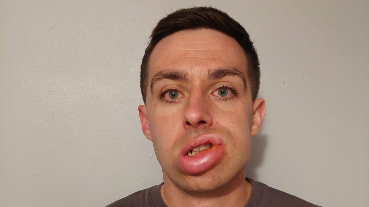 Hereditary Angioedema Patient Finds Relief in Addenbrooke’s Hospital Trial