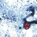 US State Faces Crisis as ‘Explosive Diarrhoea’ Infection Surges, Claiming Two Lives