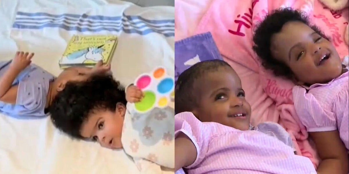 2-Year-Old Conjoined Twins Successfully Separated in 25-Hour Surgery at St. Louis Hospital 2-Year-Old Conjoined Twins Successfully Separated in 25-Hour Surgery at St. Louis Hospital