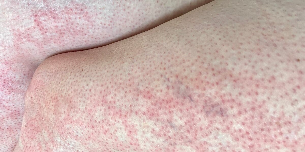 Doctors Warn of ‘Toasted Skin Syndrome’ in Children from Device Overuse