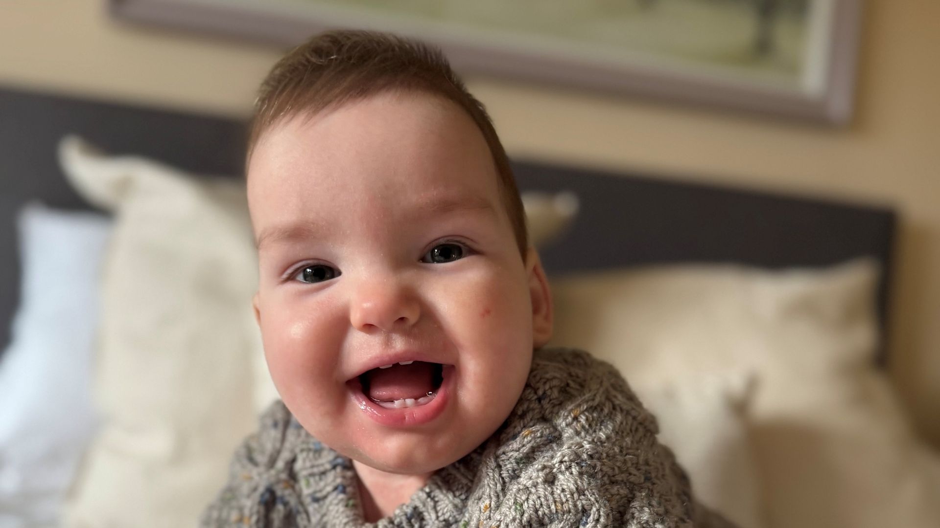 World-First Surgery Saves Baby Boy with Rare Skull Condition World-First Surgery Saves Baby Boy with Rare Skull Condition