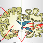POLICY WIRE FACT CHECK: Viral Newsletter Claims Genetic Discovery Reverses Alzheimer’s Brain Damage