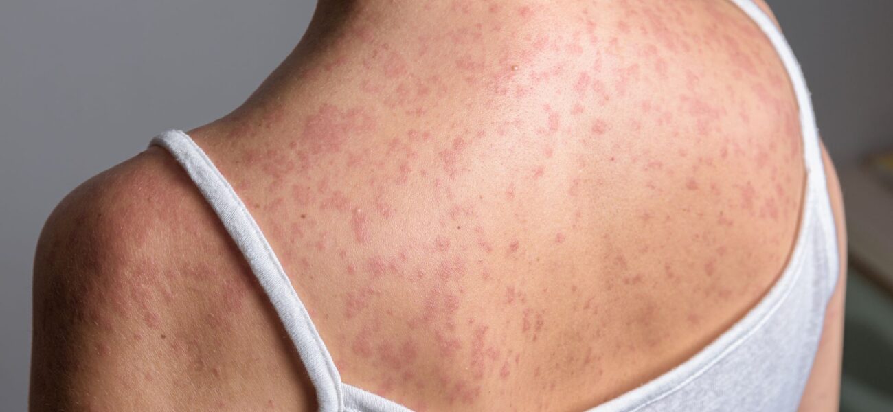 New York Declares State of Emergency Amid Measles Outbreak New York Declares State of Emergency Amid Measles Outbreak