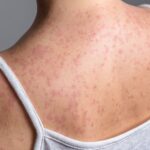 New York Declares State of Emergency Amid Measles Outbreak