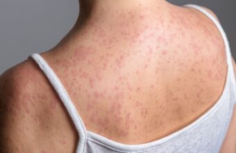 New York Declares State of Emergency Amid Measles Outbreak