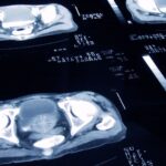 Oxford Scientists Discover Vital Clues to Predict Prostate Cancer Years in Advance